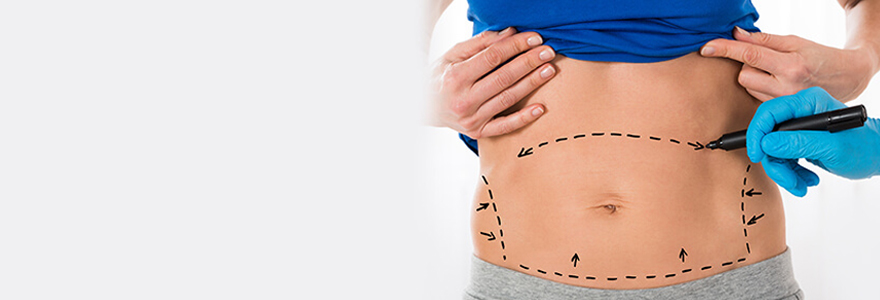 Abdominoplastie